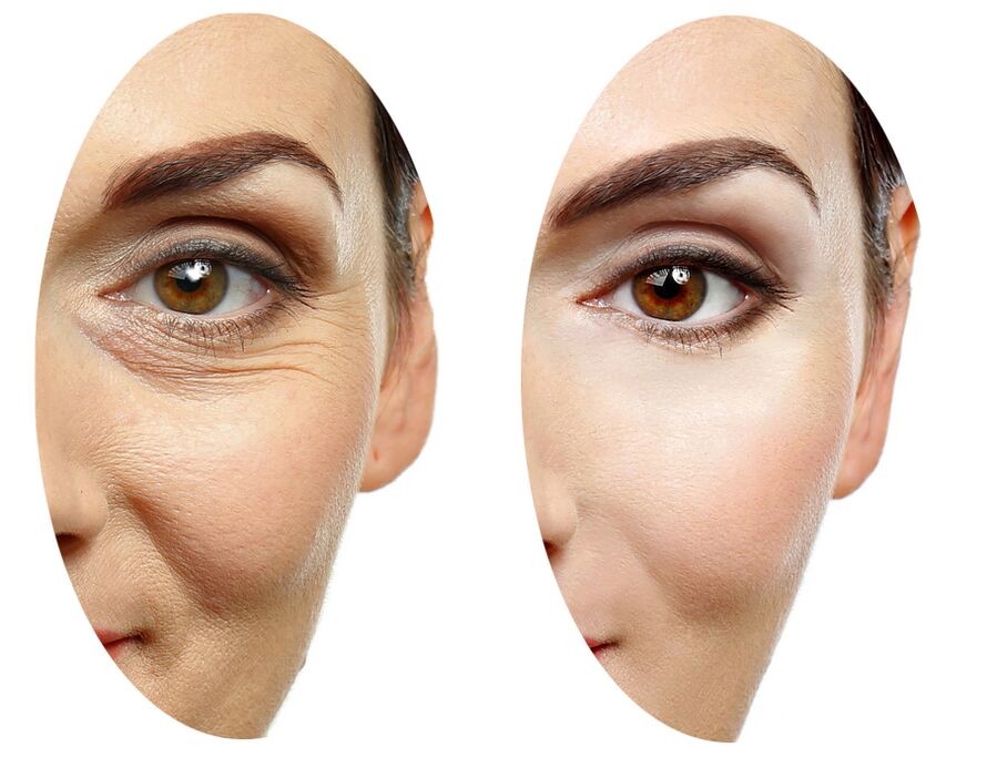 Effect of Coralift cream